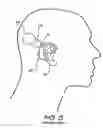 Fig. 07 - Cochlear implant having a repositionable implantable housing