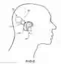 Fig. 08 - Cochlear implant having a repositionable implantable housing