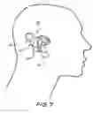 Fig. 09 - Cochlear implant having a repositionable implantable housing