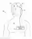 Fig. 01 - Electrical stimulation system and method for treating tinnitus