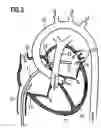 Fig. 04 - Method and apparatus for cardiac ablation