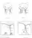 Fig. 04 - Devices and methods for repairing cardiac valves