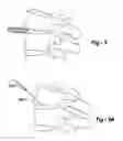 Fig. 02 - Annulus preserving methods and apparatus for placement of intradiscal devices