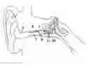 Fig. 01 - Hearing implant