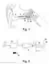 Fig. 02 - Hearing implant