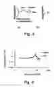 Fig. 03 - Hearing implant