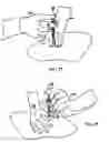 Fig. 22 - Intra-dermal delivery of biologically active agents