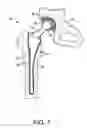 Fig. 02 - Medical device having a smooth, hardened surface