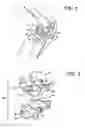 Fig. 05 - Medical device having a smooth, hardened surface