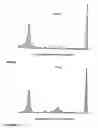 Fig. 10 - Analyzing and typing monoclonal proteins by capillary electrophoresis and immunodisplacement