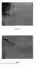 Fig. 03 - Polyphenols as an intravesical agent for the prevention of transitional cell tumor implantation