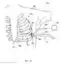 Fig. 06 - Methods and apparatus for accessing and treating regions of the body