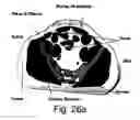 Fig. 28 - Method and system for determining a risk of ulcer onset
