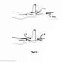 Fig. 10 - Method and system for treating tissue swelling