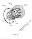 Fig. 05 - Method and apparatus for treating heart failure