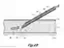Fig. 04 - Instrument for implanting sensors and solid materials in a subcutaneous location and method thereof