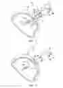 Fig. 04 - Method and apparatus for anastomosis including an expandable anchor