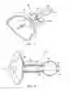 Fig. 05 - Method and apparatus for anastomosis including an expandable anchor