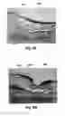 Fig. 09 - Microporation of tissue for delivery of bioactive agents