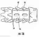 Fig. 07 - Bone fixation system and method