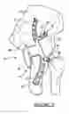 Fig. 03 - Pelvic fixation plate