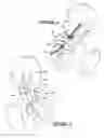 Fig. 05 - Pelvic fixation plate