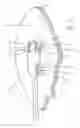 Fig. 02 - Removable implant fixing device
