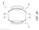 Fig. 41 - Method of implanting an intraocular lens system