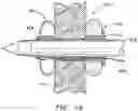 Fig. 06 - Adjustable balloon anchoring trocar