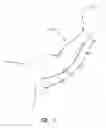Fig. 04 - Method of treating deep vein thrombosis