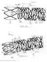 Fig. 07 - Vascular prosthesis including torsional stabilizer and methods of use