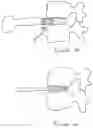 Fig. 19 - Artificial disc replacement (ADR) fixation methods and apparatus