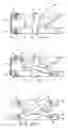Fig. 06 - Prosthetic device and method