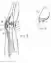 Fig. 02 - Method and apparatus for bi-compartmental partial knee replacement