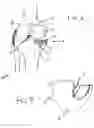 Fig. 03 - Method and apparatus for bi-compartmental partial knee replacement