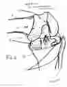 Fig. 04 - Method and apparatus for bi-compartmental partial knee replacement