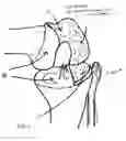 Fig. 05 - Method and apparatus for bi-compartmental partial knee replacement