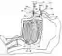 Fig. 01 - METHODS AND DEVICES FOR MAINTAINING AN OPEN AIRWAY