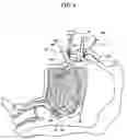 Fig. 09 - METHODS AND DEVICES FOR MAINTAINING AN OPEN AIRWAY