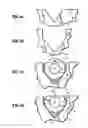 Fig. 05 - Devices and methods for side-coupling optical fibers to optoelectronic components