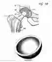 Fig. 04 - Bone restorative carrier mediums