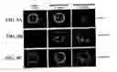 Fig. 12 - Antibodies which bind to proteins involved in cytoadhesion of plasmodlum falciparum ring-stage-infected erythrocytes