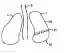 Fig. 01 - Method for non-invasive lung treatment