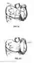 Fig. 04 - Method for non-invasive lung treatment
