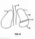 Fig. 07 - Method for non-invasive lung treatment