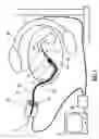 Fig. 02 - Method for transcutaneous catheter guiding