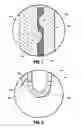 Fig. 06 - Pneumoperitoneum needle