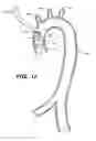 Fig. 09 - Multichannel catheter