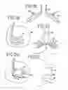 Fig. 06 - Transmural ablation device