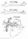 Fig. 44 - Transmural ablation device